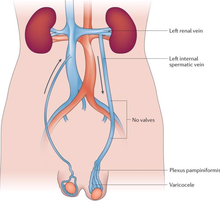 varicocele embolisation1